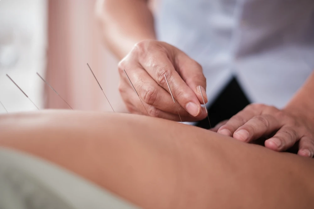 dry needling